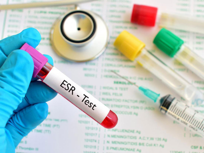 ESR giúp phát hiện tình trạng viêm xuất hiện trên cơ thể