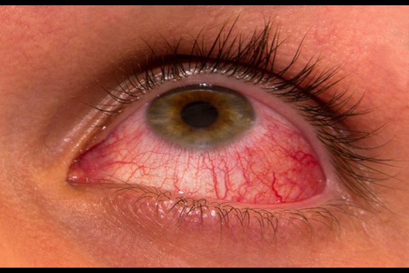 Viêm mống mắt rất dễ gây biến chứng nếu không được kịp thời điều trị