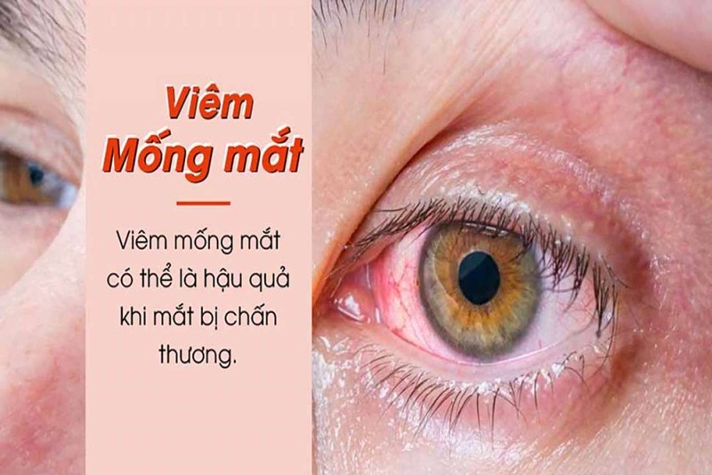 Viêm mống mắt có thể do chấn thương mắt gây ra