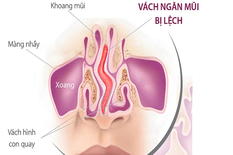 Bị lệch vách ngăn mũi cũng là yếu tố làm tăng nguy cơ bị bệnh