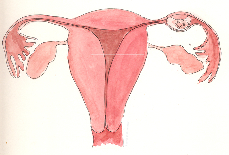 Hình ảnh minh họa vị trí thai có thể hình thành ở ngoài tử cung