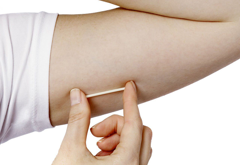 Que cấy tránh thai được cấy ở mặt dưới của cánh tay không thuận