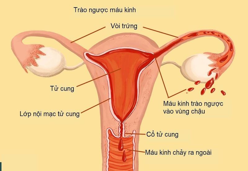 Lạc nội mạc tử cung xảy ra khi tế bào nội mạc tử cung tồn tại ở bên ngoài buồng tử cung của phụ nữ