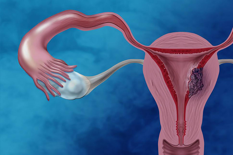 U nang là một căn bệnh vô cùng nguy hiểm và có thể gây nên tình trạng đau ở buồng trứng