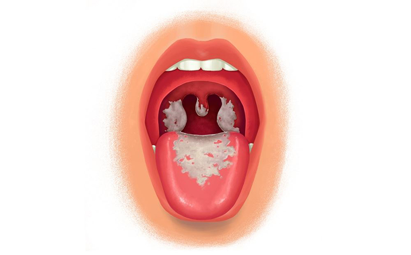 Bệnh nhân bị bạch hầu thể họng xuất hiện những mảng giả đục bám ở vòm họng
