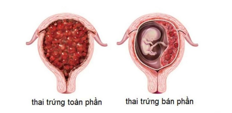 Hình ảnh minh hoa thai trứng toàn phần và bán phần tại tử cung người phụ nữ.