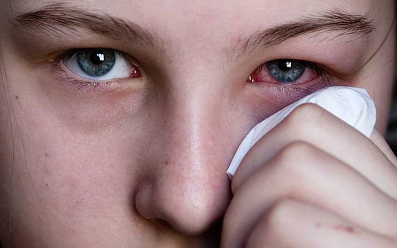 Viêm kết mạc cấp tính hay còn gọi là bệnh đau đỏ mắt