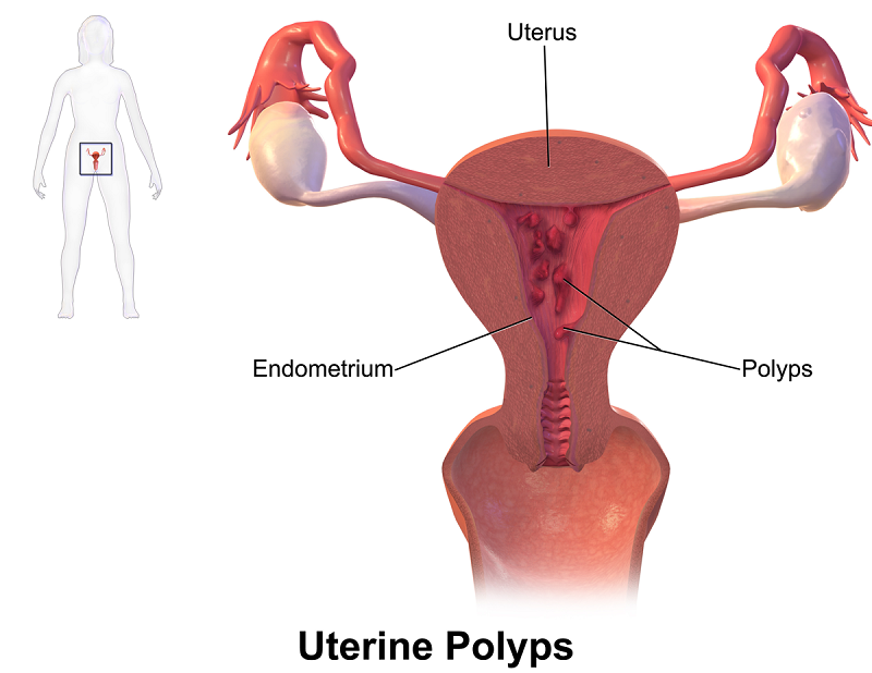 Hình ảnh minh họa polyp cổ tử cung có tái phát không