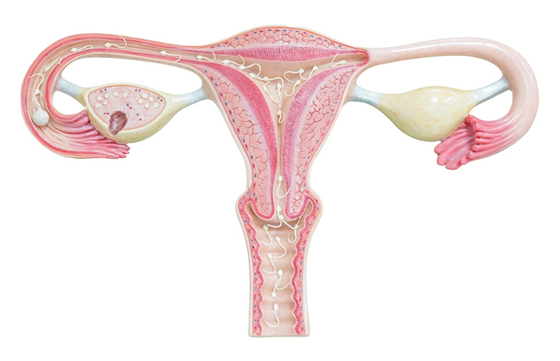 Lạc nội mạc tử cung có thể là nguyên nhân gây nên tình trạng đau lưng khi có kinh nguyệt ở phụ nữ