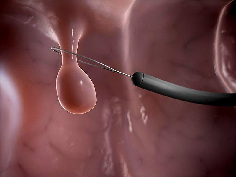 Minh họa điều trị xoắn polyp cổ tử cung