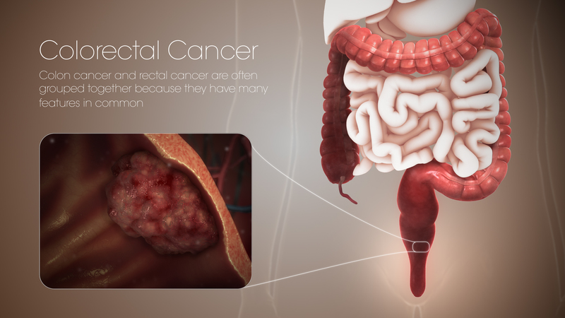 Ung thư có thể phát triển tại nhiều vị trí khác nhau của đại trực tràng