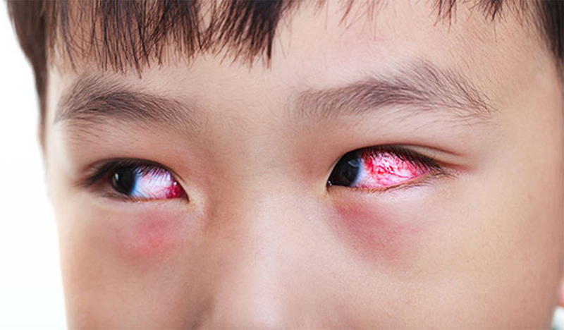 Nhiễm trùng mắt được xem là một trong những nguyên nhân gây mờ mắt 