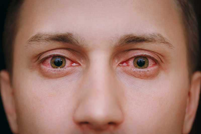Viêm kết mạc mãn tính hay còn gọi là bệnh đỏ mắt