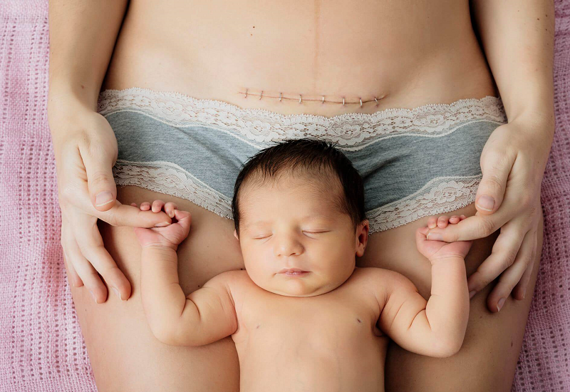Bị bệnh trĩ khi mang thai có thể khiến mẹ bầu không thể sinh thường