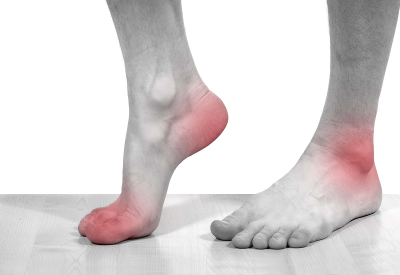 Bị tê ngón chân cái có thể là triệu chứng của bệnh Gout