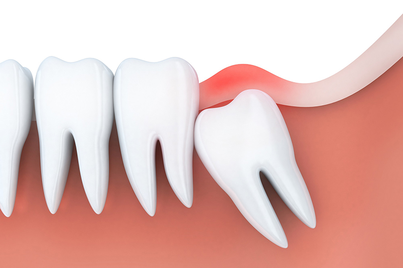 Nhổ răng khôn bao lâu thì lành là thắc mắc của bệnh nhân