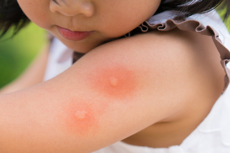 Các nốt mẩn đỏ sẽ bắt đầu xuất hiện trên da khiến trẻ bị ngứa như châm chích