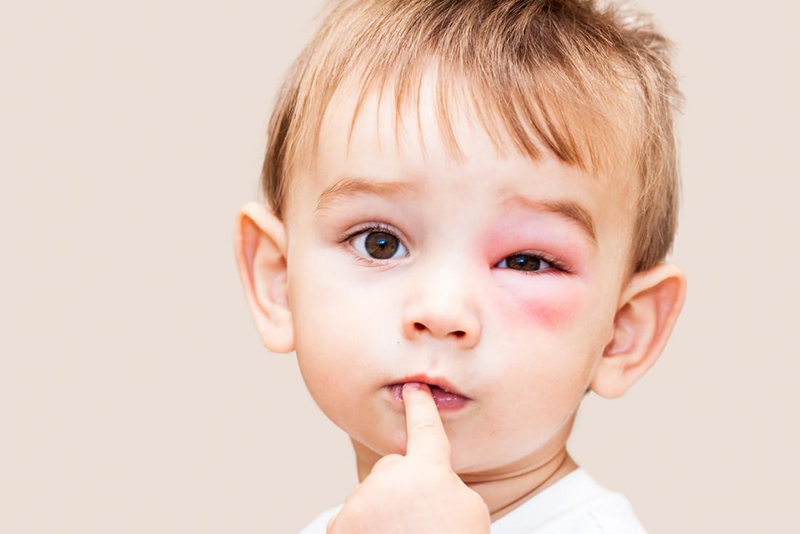 Cách điều trị vết côn trùng đốt ở trẻ em, bố mẹ nên sử dụng túi chườm đá hoặc khăn lạnh đắp lên vết thương