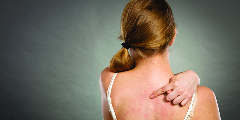 Người bị viêm da cơ địa thường có biểu hiện ngứa ngáy và nổi vết chàm đỏ trên da