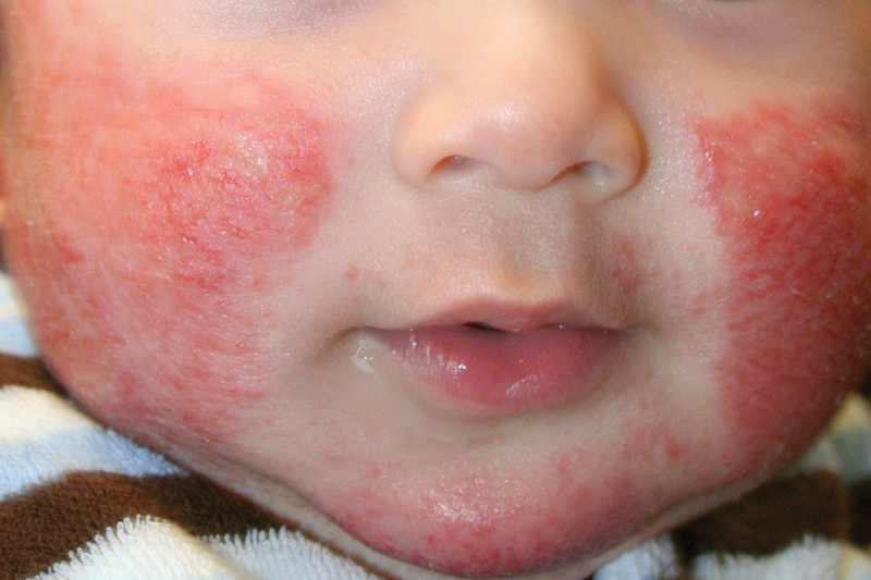 Viêm da cơ địa khiến vùng da mặt bị ngứa, nổi mẩn đỏ và tổn thương nặng nề