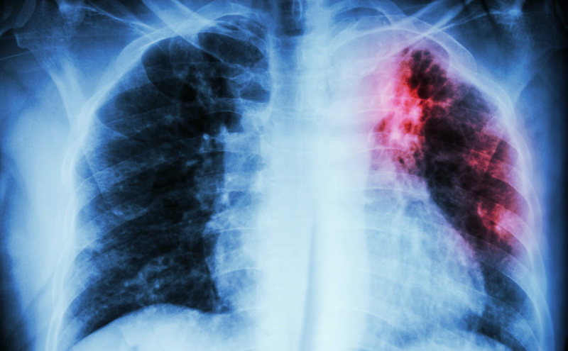 Lao phổi thường gây biến chứng tràn khí màng phổi tự phát