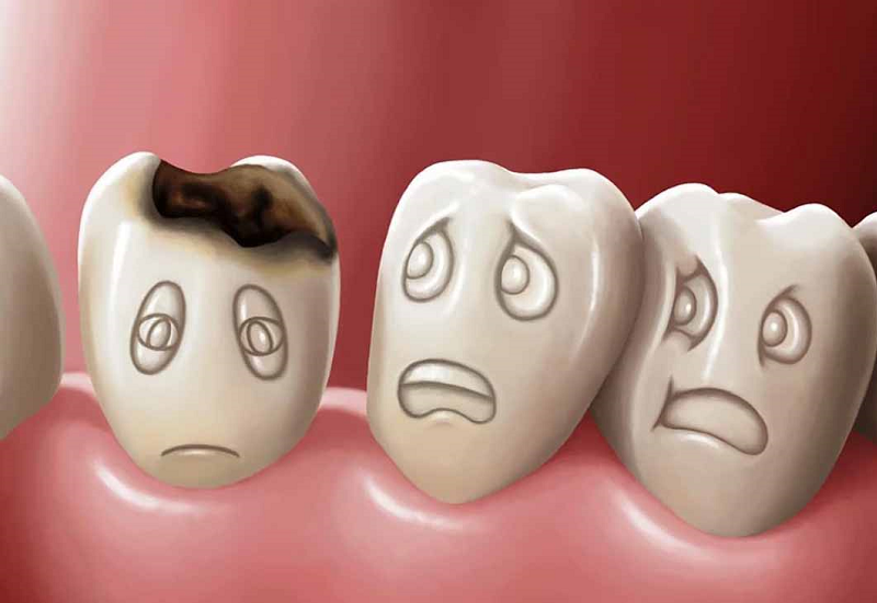 Tình trạng nghiến răng khi ngủ kéo dài có thể khiến răng bị sâu