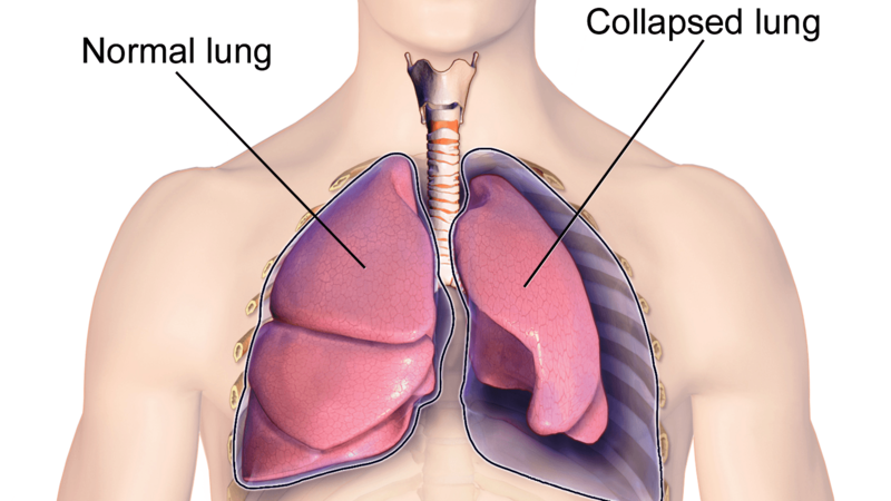 triệu chứng xẹp phổi có nguy cơ tiến triển thành suy hô hấp