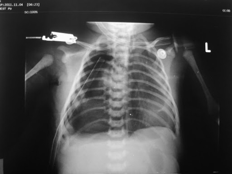 Bệnh nang tuyến phổi bẩm sinh trên ảnh chụp X-quang