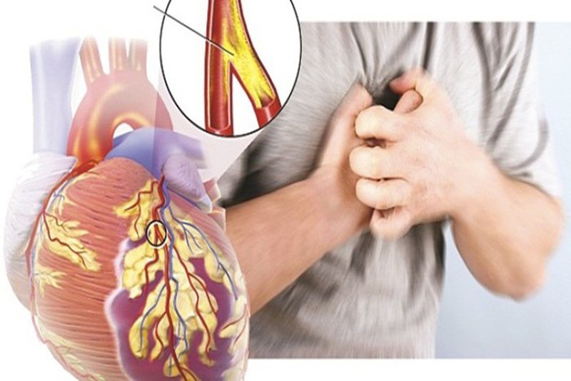 Đau thắt ngực là biểu hiện điển hình nhất của bệnh mạch vành tim
