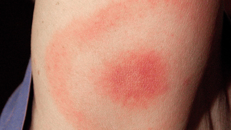 Sưng đỏ là một trong những phản ứng thông thường xuất hiện sau khi tiêm chủng cho trẻ