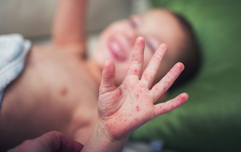 Trẻ em có sức đề kháng yếu nên rất dễ bị nhiễm bệnh, trong đó có bệnh tay chân miệng