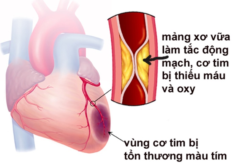 Xác định vị trí nhồi máu cơ tim là cần thiết để điều trị bệnh