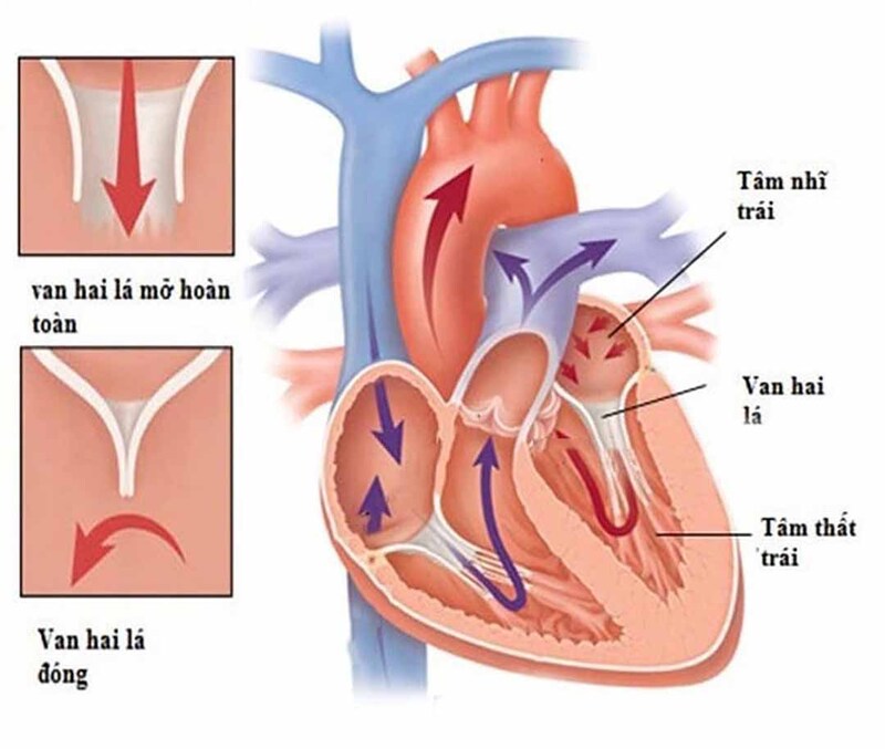 Hở van hai lá khiến máu bị trào ngược về buồng tim sau khi bơm ra ngoài