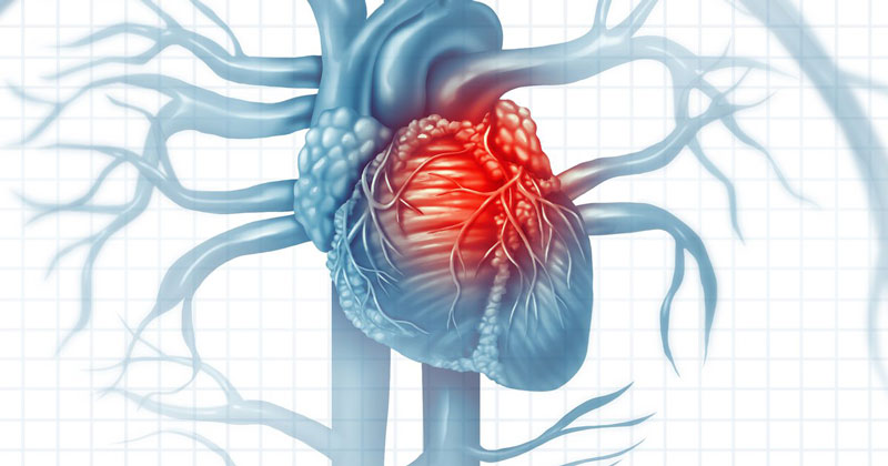 Thiếu máu cơ tim dẫn đến nhiều vấn đề nghiêm trọng như đau thắt ngực, nhồi máu cơ tim