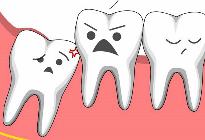 Những người răng bị lệch dễ có nguy cơ bị rối loạn khớp thái dương hàm