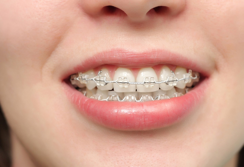 Niềng răng có thể giúp chữa bệnh rối loạn khớp thái dương hàm