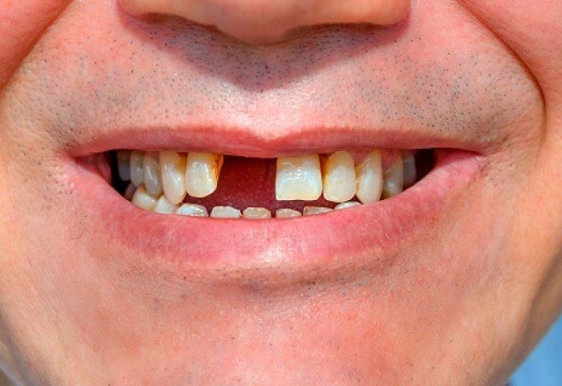 Tình trạng tụt lợi có thể khiến người bệnh bị mất răng