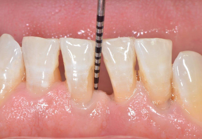 Hiện tượng các răng dần dần bị thưa là triệu chứng của bệnh tụt lợi