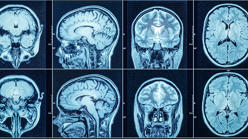 Chụp cộng hưởng từ MRI sọ não