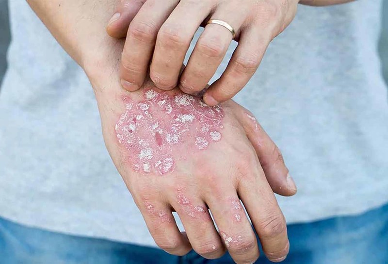 Bệnh chàm da có thể gây khô ngứa và tróc da ở cả các bộ phận khác