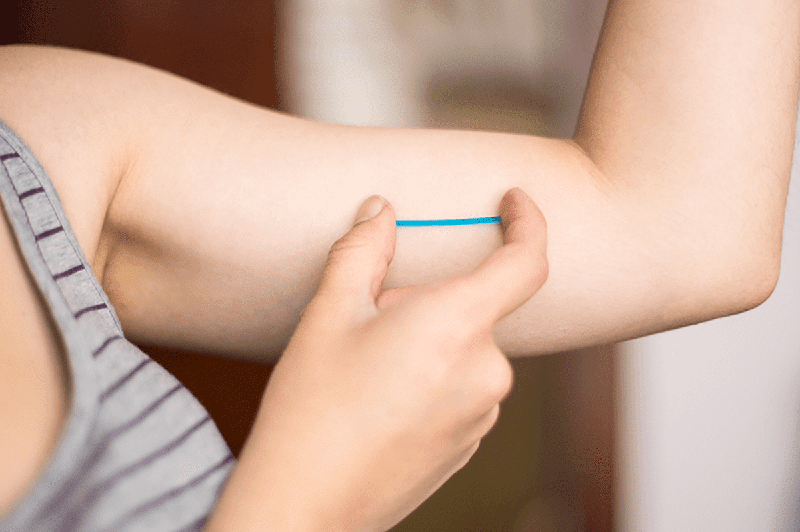 Que tránh thai được cấy vào vùng da dưới cánh tay không thuận của các chị em