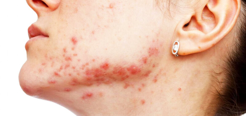 Kén nang lông vùng da mặt thường nghiêm trọng và khó điều trị