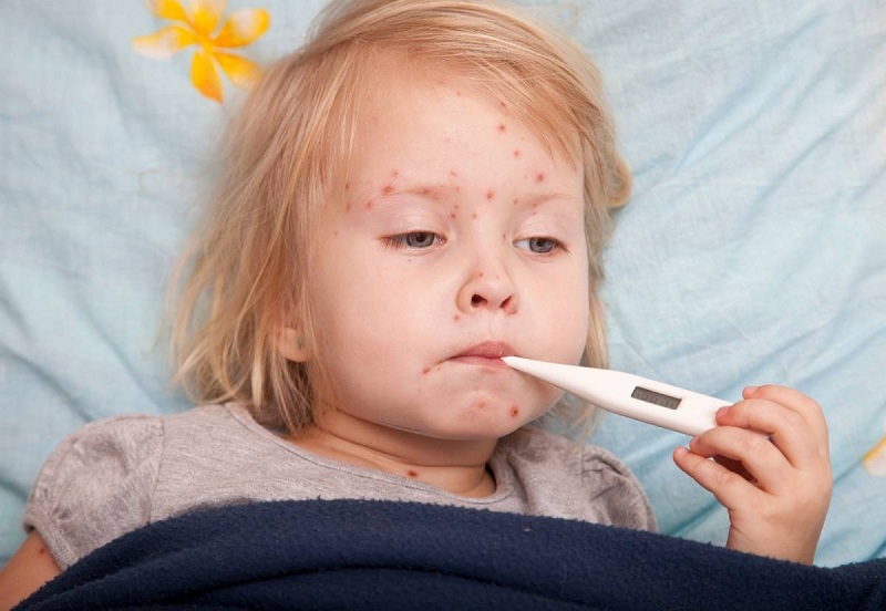 Trẻ bị sởi nếu sốt kéo dài, dùng thuốc hạ sốt đúng liều mà không hạ sốt cần đến cơ sở y tế ngay
