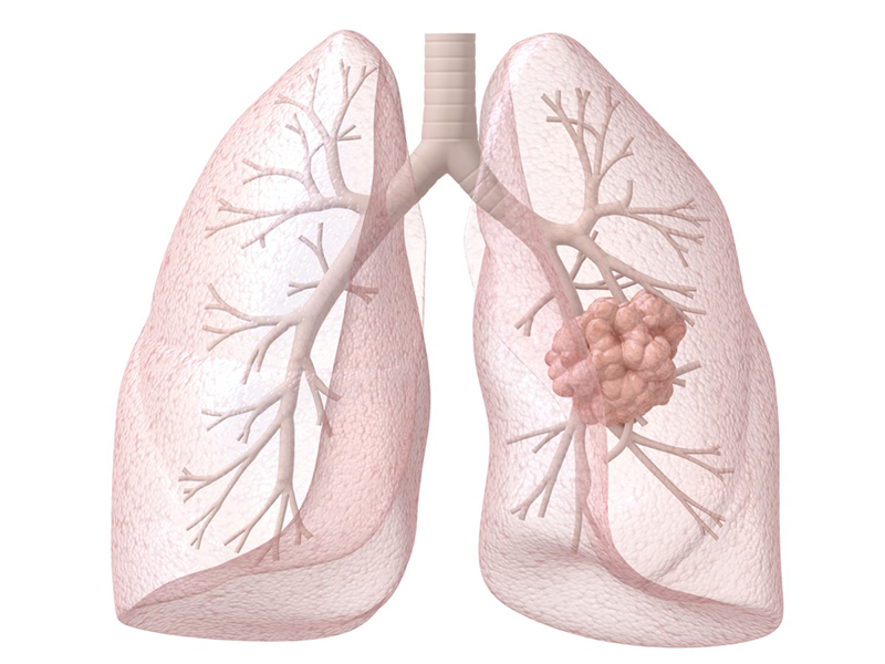 Chẳng bao lâu các tế bào ung thư này sẽ ăn mòn các tế bào phổi nếu không ngăn chặn kịp thời