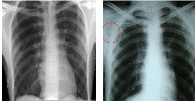 Chụp X-quang giúp đánh giá tình trạng tổn thương trong viêm màng phổi