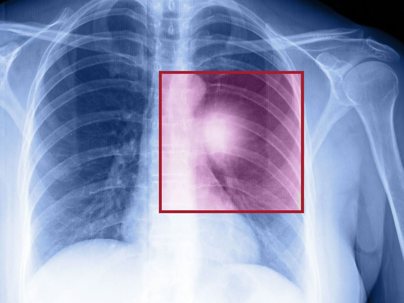 Tràn dịch màng phổi ác tính rất nguy hiểm và dễ tái phát