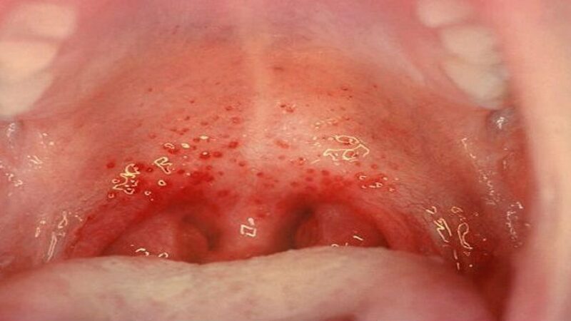 Triệu chứng viêm họng và viêm amidan do liên cầu khuẩn