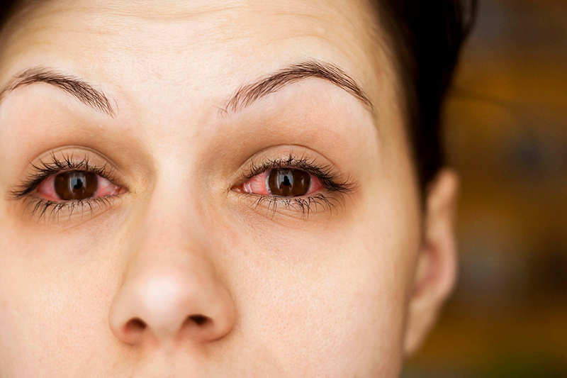 Đỏ mắt là một trong những triệu chứng cảnh báo thị lực bất thường