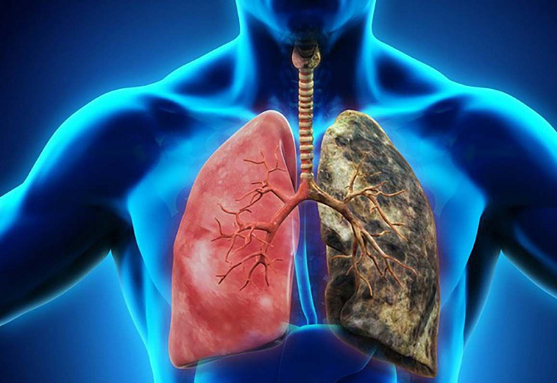 Tầm soát để xác định ung thư phổi
