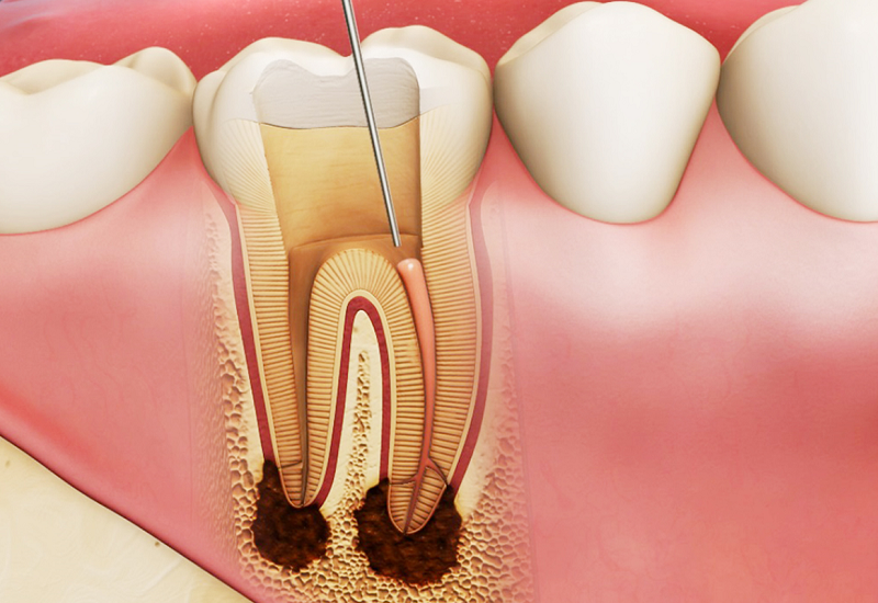 Trường hợp tủy răng bị hoại tử thì người bệnh cần được triệt tủy răng nhằm hạn chế các biến chứng bệnh nguy hiểm